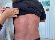 Prevalensi Kusta di Sulawesi Barat Masih Tinggi, Dinkes Perkuat Deteksi Dini dan Pengobatan